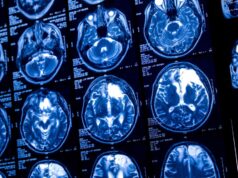 El tratamiento de la epilepsia se ve afectado en el 20% de los casos por depresión o ansiedad