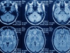 Astuce advierte sobre la lucha contrarreloj de pacientes con glioblastoma para acceder a un tratamiento clave