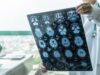 ASTUCE Spain solicita a Sanidad protección oficial para el oligodendroglioma