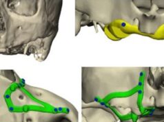 La realidad extendida y la planificación digital transforman la implantología avanzada