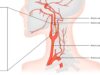 Una enfermedad silenciosa de las arterias carótidas puede acabar provocando un ictus