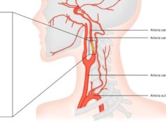 Una enfermedad silenciosa de las arterias carótidas puede acabar provocando un ictus