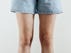 Varices después del verano: las señales que aconsejan una valoración médica