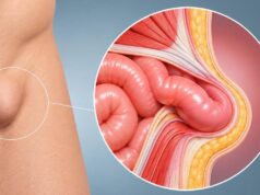 Operarse de una hernia y dormir en casa: cuándo es posible evitar el ingreso hospitalario